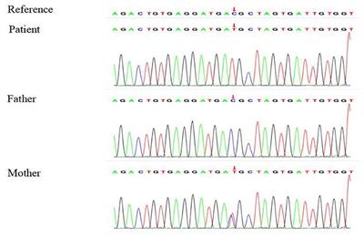 Case Report: A Case of Congenital Nephrogenic Diabetes Insipidus Caused by Thr273Met Mutation in Arginine Vasopressin Receptor 2